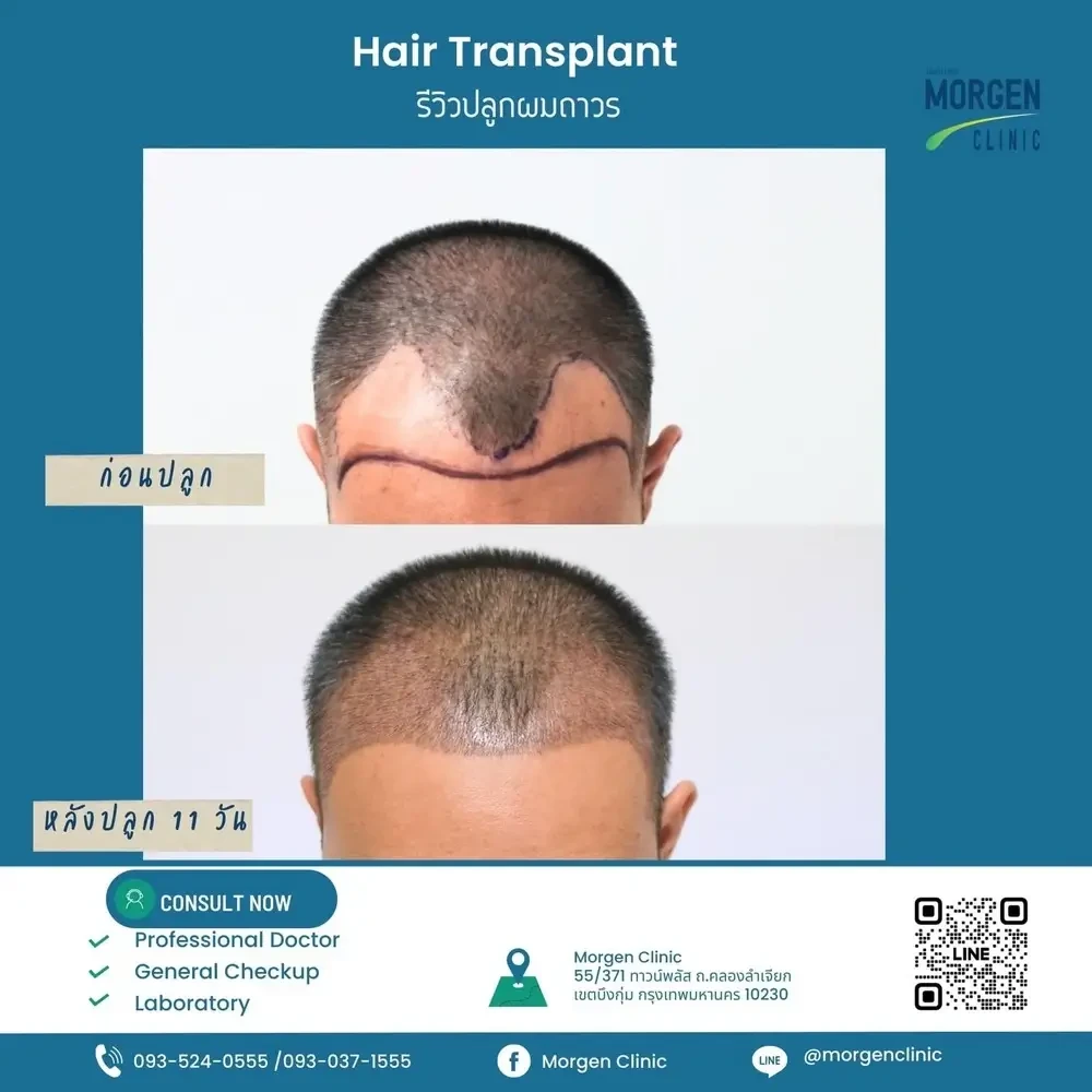 รีวิวปลูกผม