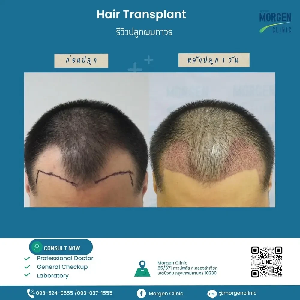 รีวิวปลูกผมถาวร